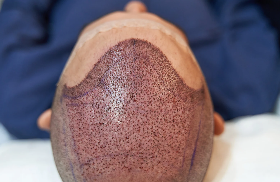 חשיפה לשמש אחרי השתלת שיער