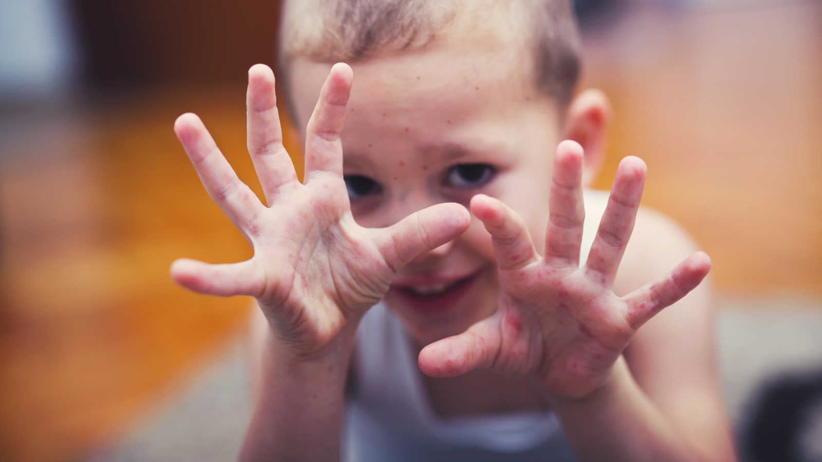 מחלת הפה והגפיים