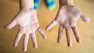 מחלת הפה והגפיים