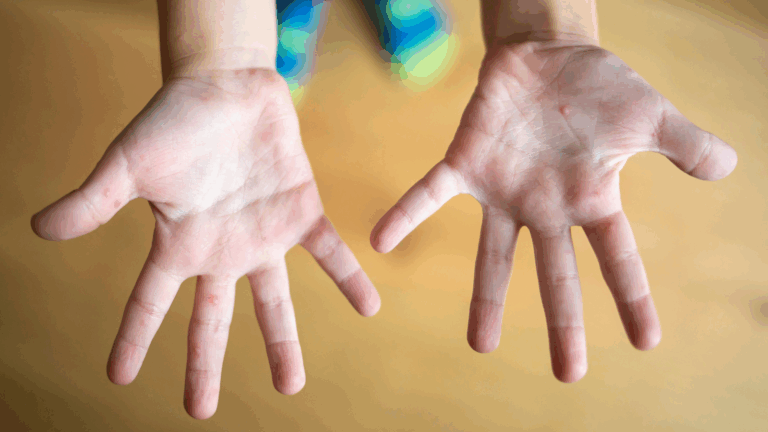 מחלת הפה והגפיים