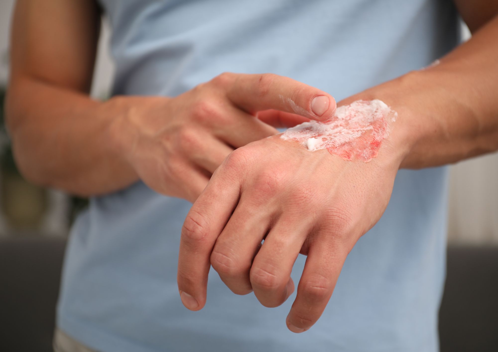 טיפול בכוויות