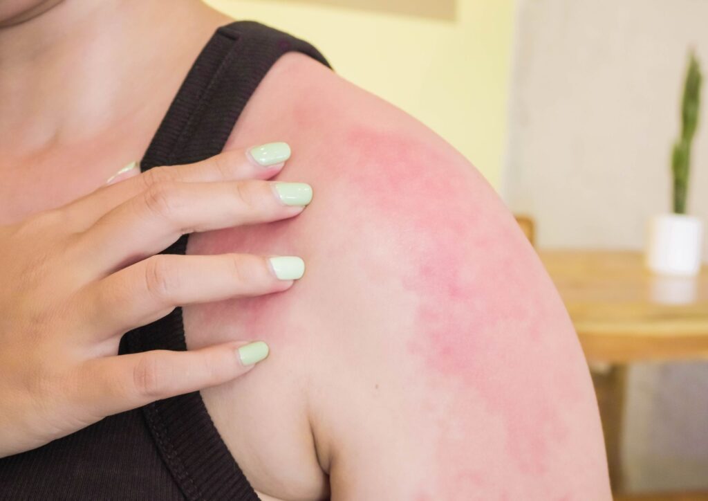 טיפול בכוויות